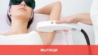 Лазерная эпиляция