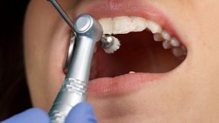 Гигиена полости рта в стоматологии «АсторДент»