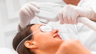 Удаление пигментации в клинике косметологии O-laser
