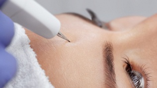 Удаление новообразований в клинике эстетической медицины Icon Estetic