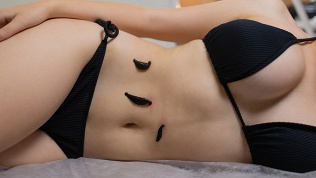 Гирудотерапия в клинике «Фитоцентр Юлии Мирт»