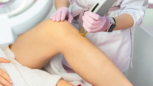 Эпиляция александритовым лазером в клинике эстетической косметологии Ingart