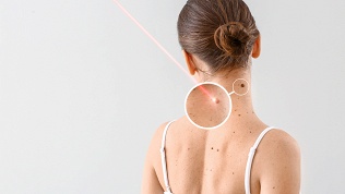 Удаление новообразований в учебно-косметическом центре Cosmo Profi