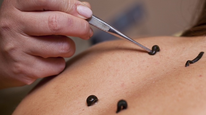 Скидки, Сеансы гирудотерапии, купоны от Biglion в Краснодаре