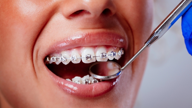 Установка брекетов